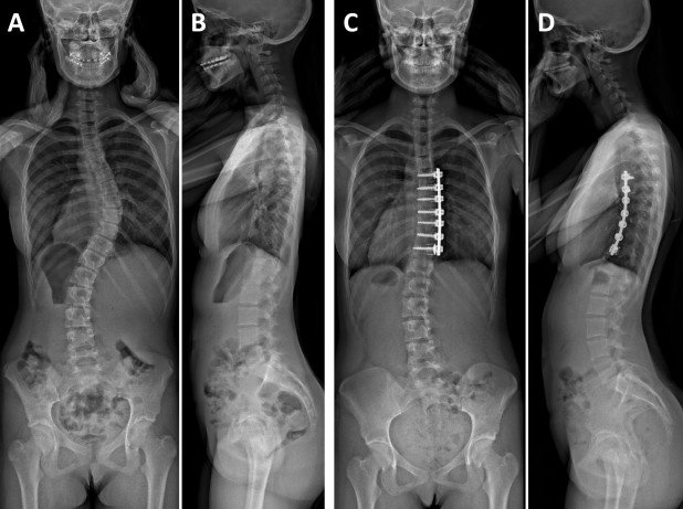 Vorderer Zugang bei idiopathischer Skoliose