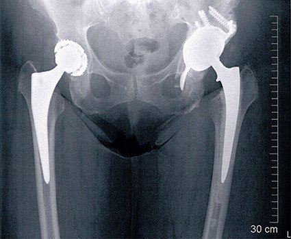 Postoperatives Röntgenbild Hüftpfanne