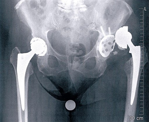 Praeoperatives Röntgenbild: Die Pfanne ist aus dem Becken ausgerissen