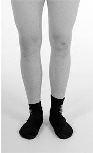 X-Beinkorrektur postoperativ
