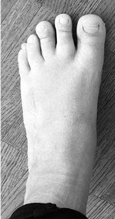 Zehenverlängerung bei Brachydaktylie nach OP