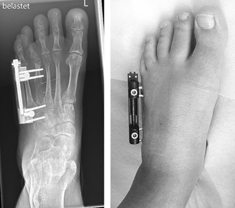 Zehenverlängerung bei Brachydaktylie Therapie