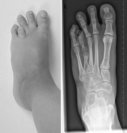 Zehenverlängerung bei Brachydaktylie vor OP