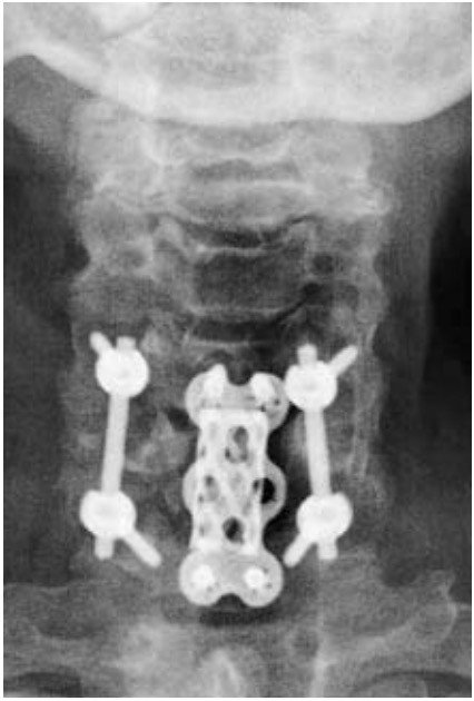 Halswirbelsäule Implantate
