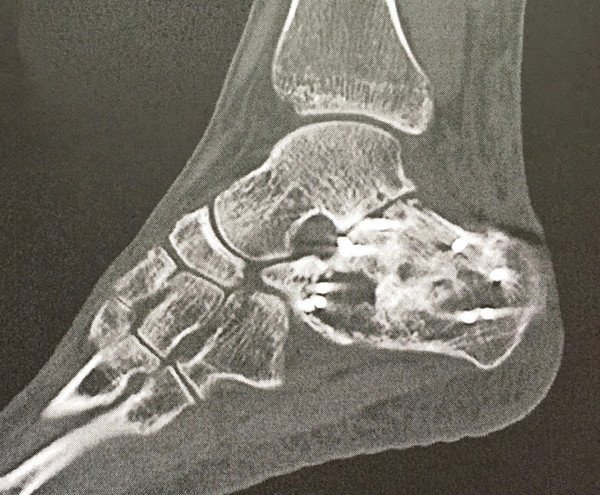 Arthrose des unteren Sprunggelenkes