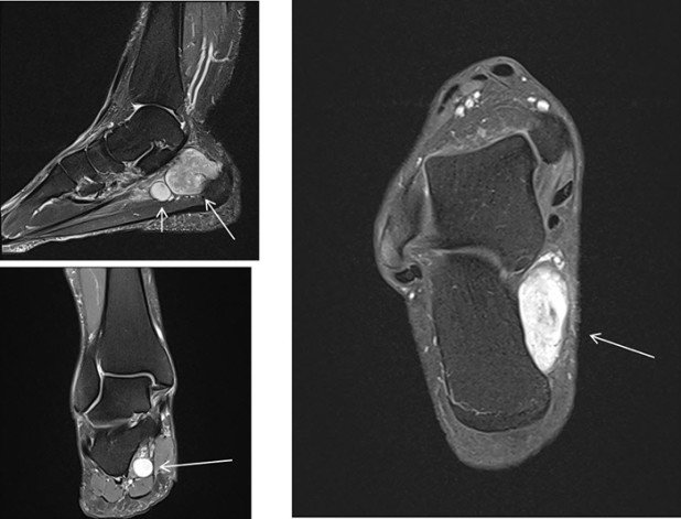 Magnetresonanz-Untersuchung Tumor