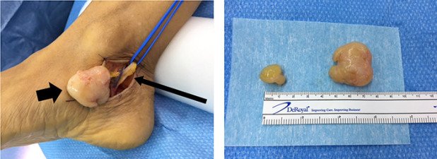 Tumorgewebe und freigelegter Nerv