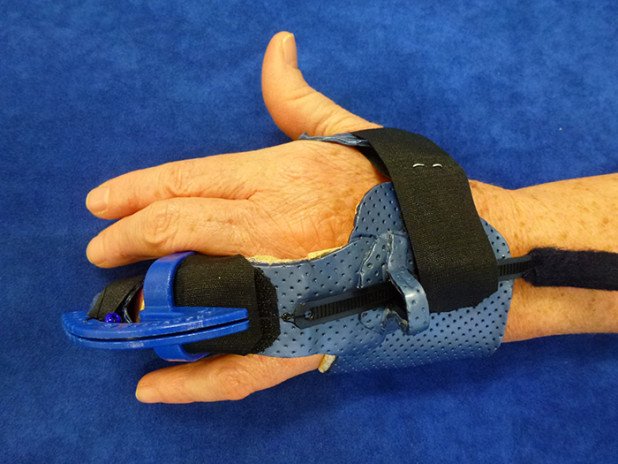 Fixation der Isoforce-Schiene Ergotherapie