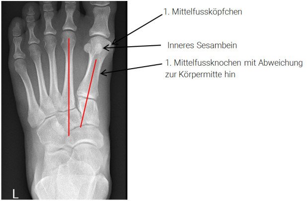 Röntgenbild juvenile Hallux valgus-Deformität