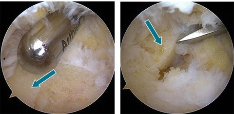 Minimal-invasive Behandlung einer Haglund-Ferse