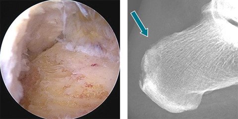 Minimal-invasive Behandlung einer Haglund-Ferse mit Röntgenbild nachher