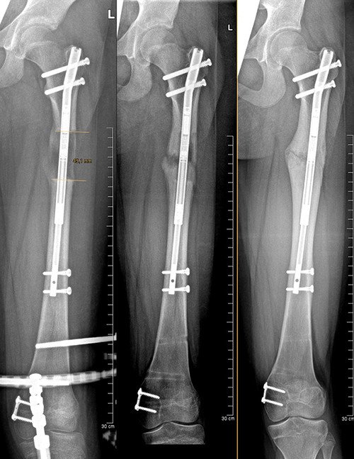 Röntgenbild Knochenverlängerung