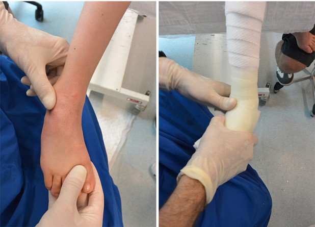 Behandlung eines schweren Klumpfusses mit Unterschenkel-Gips