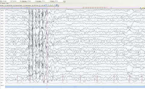 EEG beijuveniler Absence-Epilepsie nach der Hyperventilation