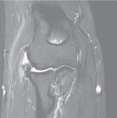 MRI-Bild Tennisarm mit gerissener Sehne
