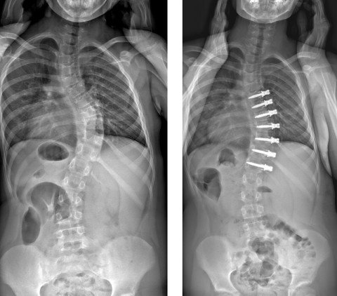 Röntgenbilder, vor und nach bewegungserhaltender Skoliose-Operation