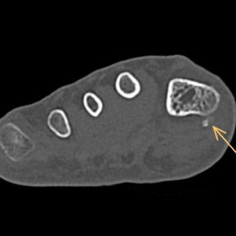 Plantarer Osteophyt
