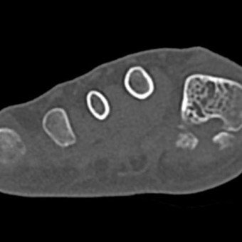 Plantarer Osteophyt