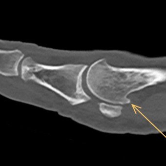 Plantarer Osteophyt