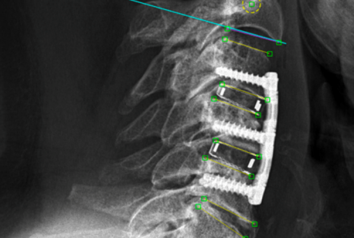 Röntgenbild Wirbelsäule