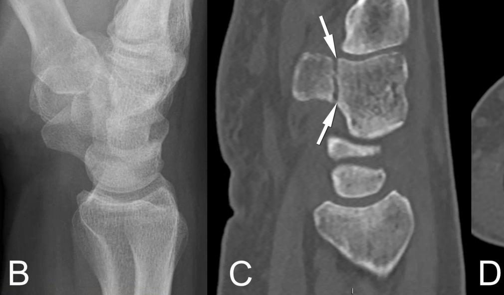 Bildgebung Fraktur der Basis des Hamulus ossis hamati
