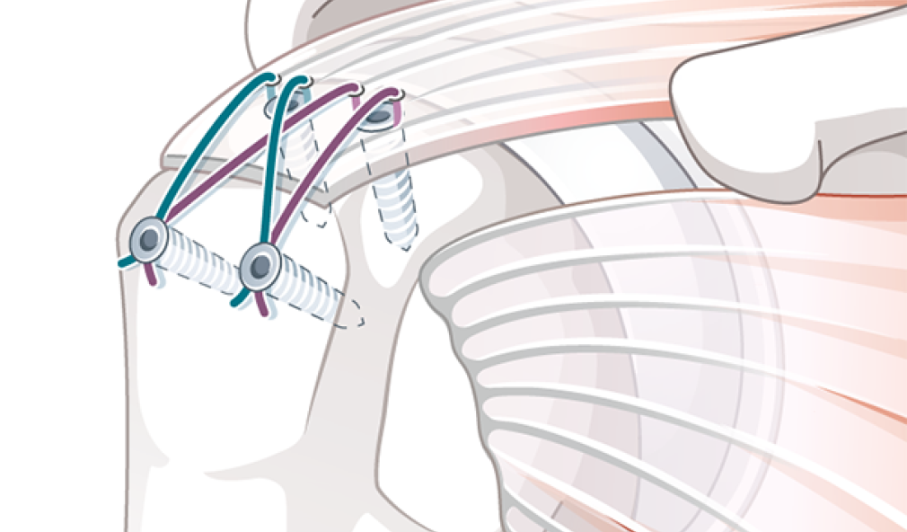 Illustration Rotatorenmanschetttenruptur: Fertig fixierte Sehne mittels Fadenankersystem