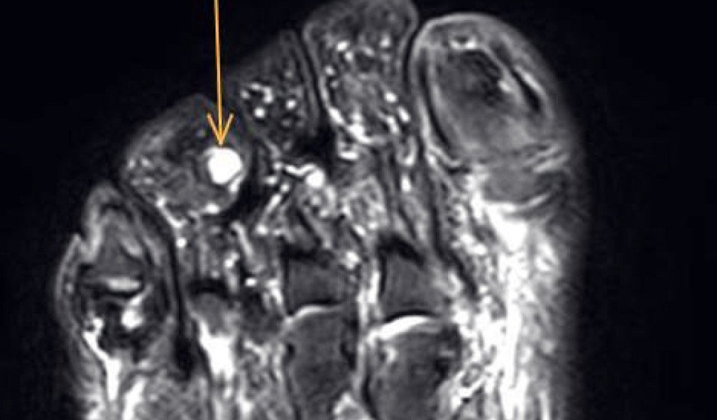 MRI eines Schwannoms (Tumors) in der Zehe