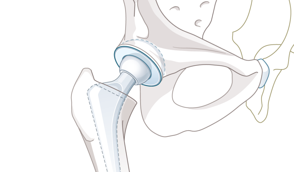Illustration Hüftprothese