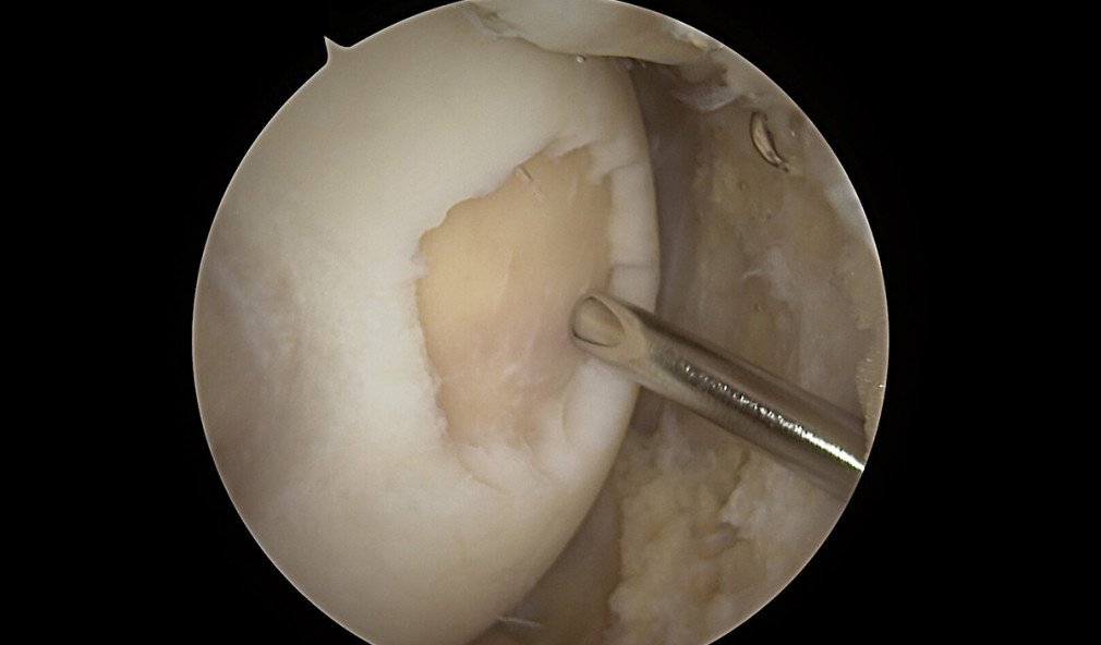 Knorpelschaden Knie: Aufbereitung für Knorpelchips-Implantation