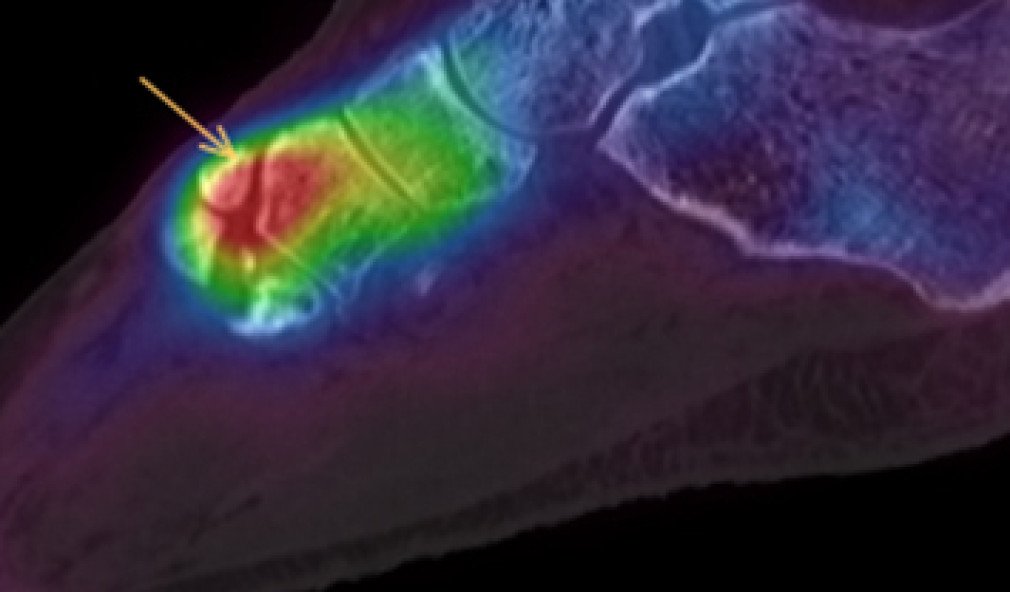  Spect-CT-Bild beginnende Arthrose Lisfranc-Gelenke