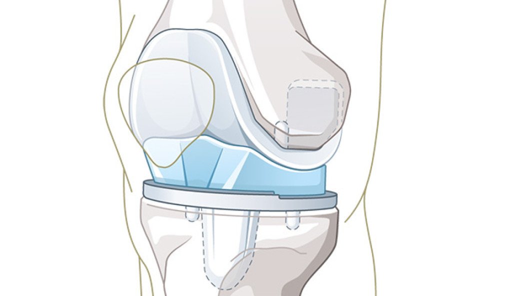 Illustration Knieprothese