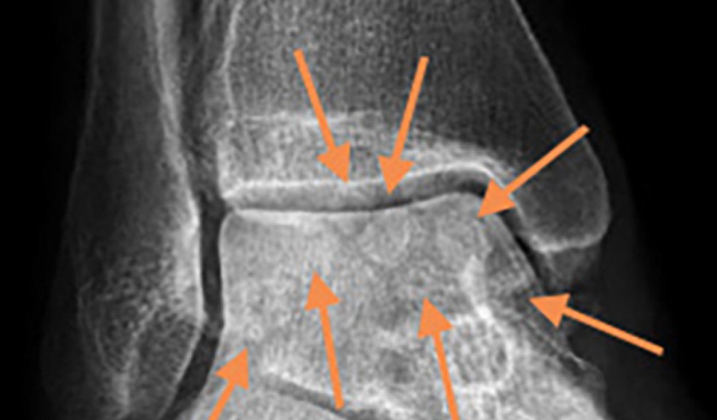 Röntgenbild mit Chondromatose am Sprunggelenk