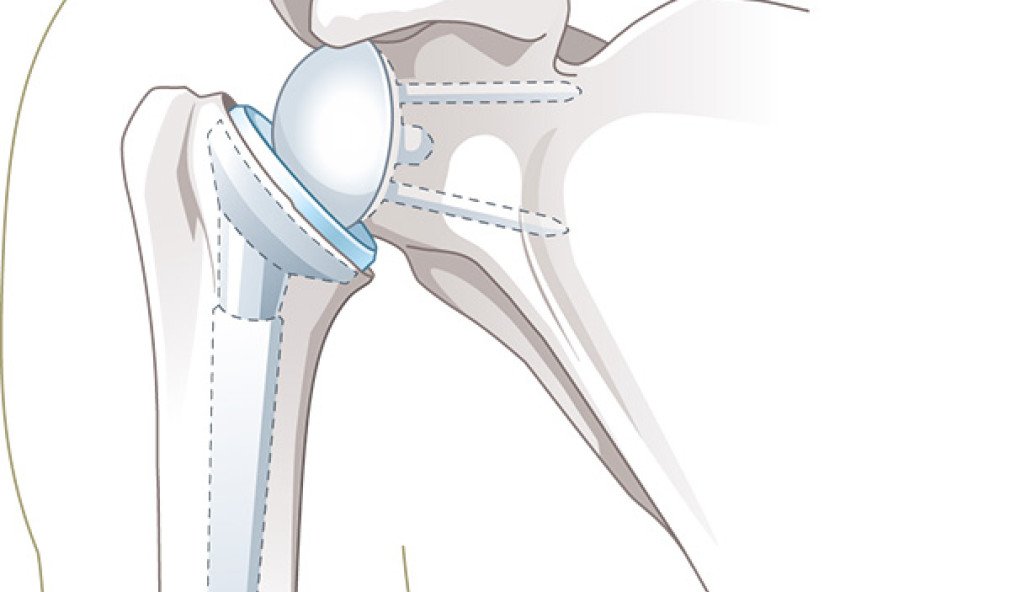 Illustration inverse Schulterprothese
