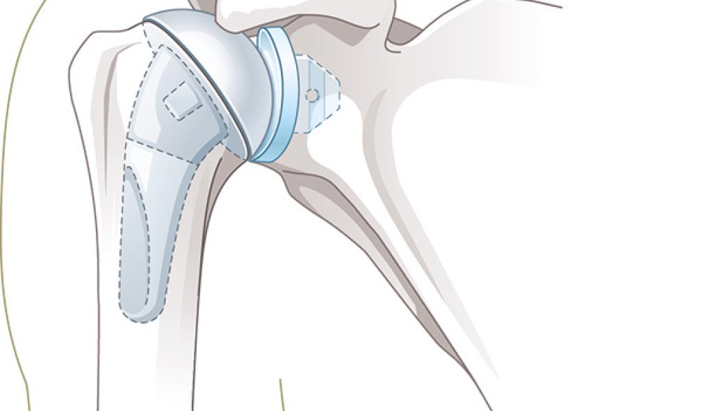 Illustration Schulterprothese