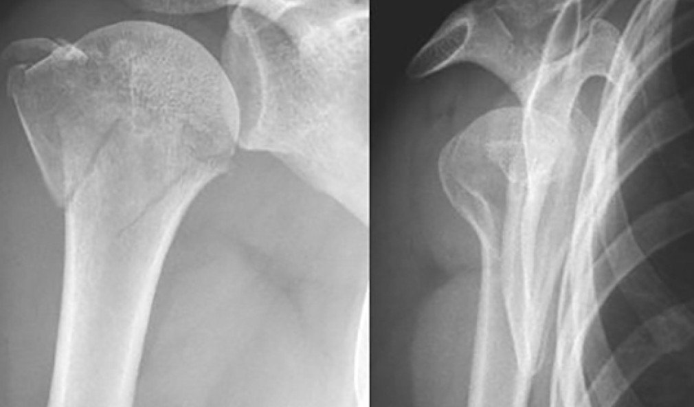 Röntgenbild proximale 3-Fragmenthumerusfraktur