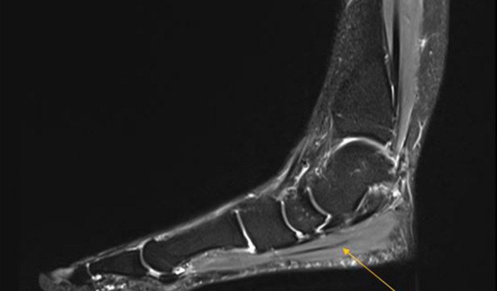 MRI-Bild Fuss mit belastungsinduziertem Logensyndrom