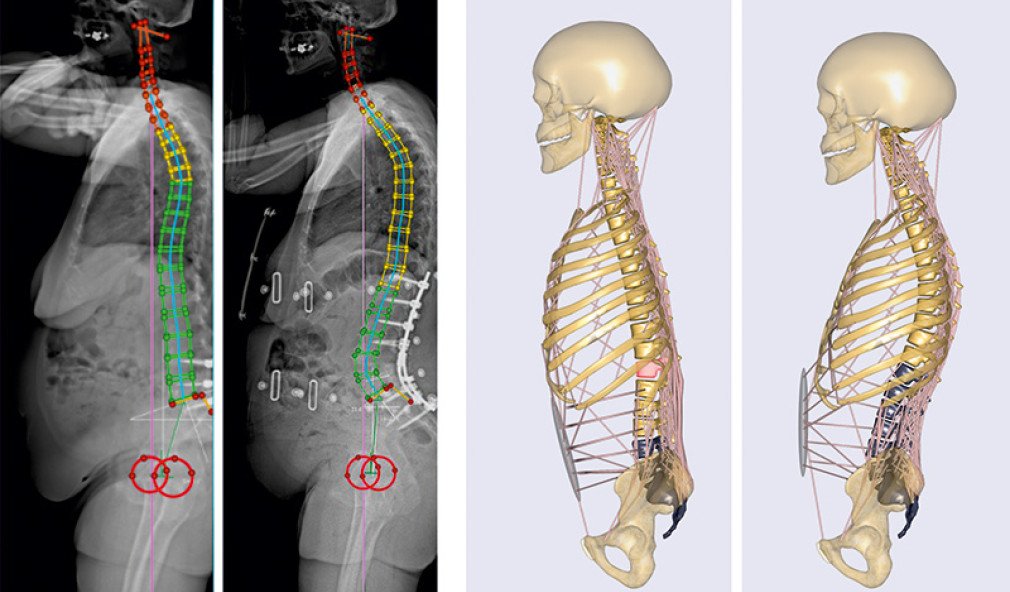 Röntgenbilder und Computersimulationen Belastungen der Wirbelsäule