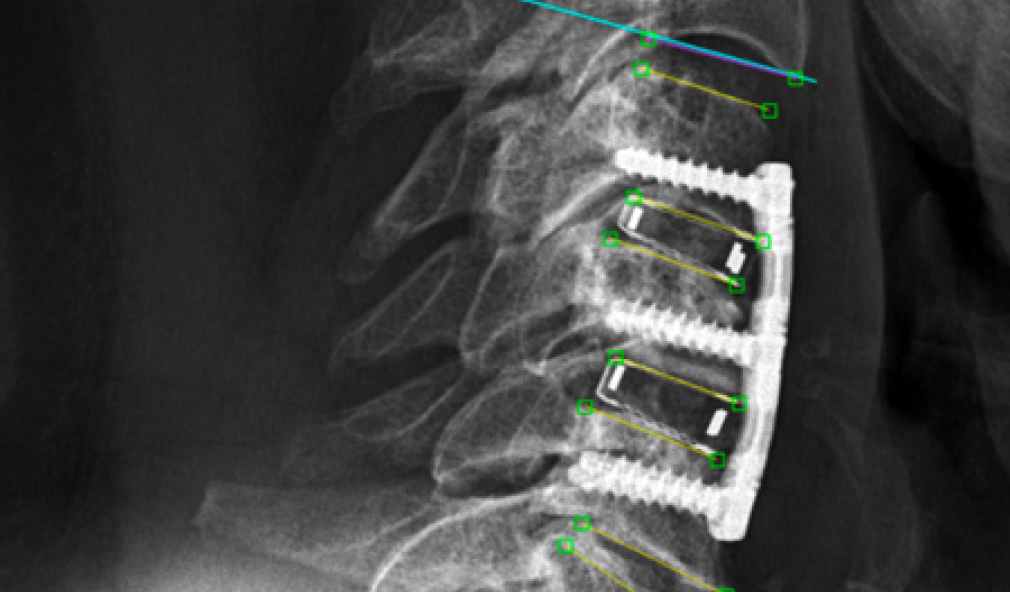 Röntgenbild Wirbelsäule