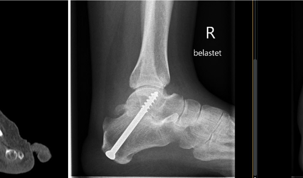 Arthrose unteres Sprunggelenk vorher nachher