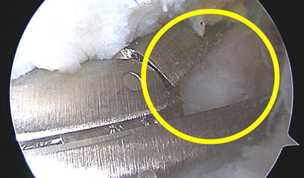 Arthroskopie oberes Sprunggelenk