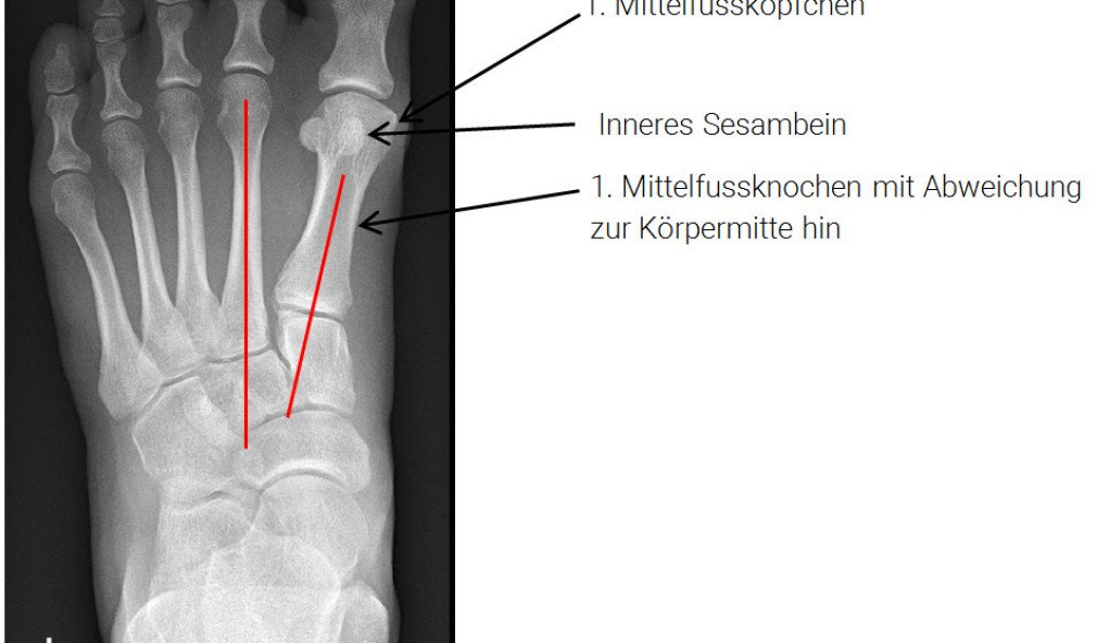 Röntgenbild juvenile Hallux valgus-Deformität