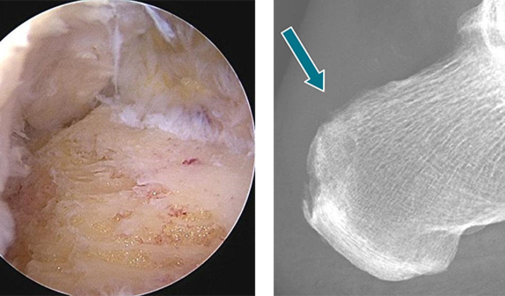 Minimal-invasive Behandlung einer Haglund-Ferse mit Röntgenbild nachher