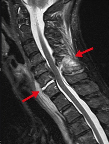 MRI Halswirbelsäule mit Verletzung zwischen 6. und 7. Halswirbelkörper