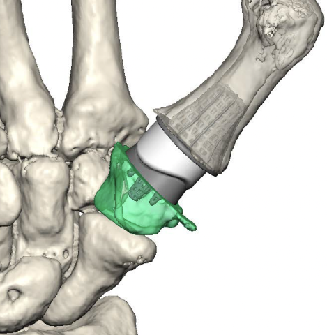 Abbildung eines Daumensattelgelenk-Implantats