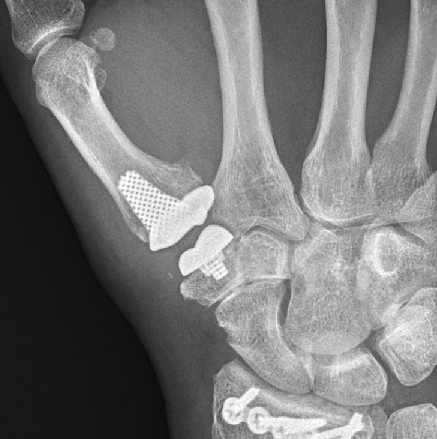 Abbildung eines Daumensattelgelenk-Implantats