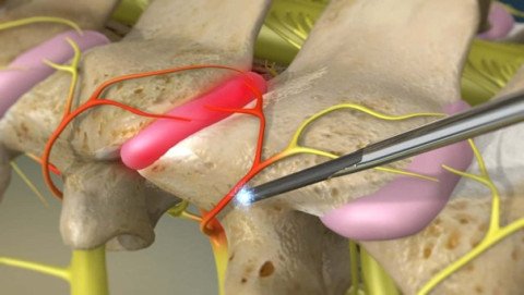 Thermoablation oder thermische Verödung