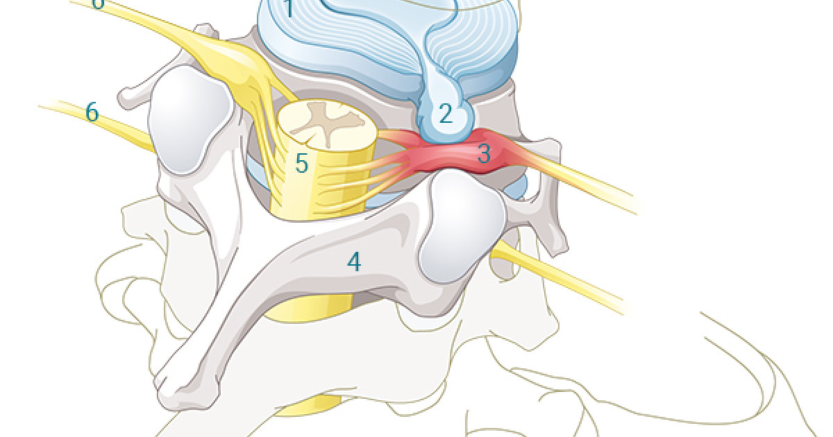 Bandscheibenvorfall An Der Halswirbelsaule Schulthess Klinik
