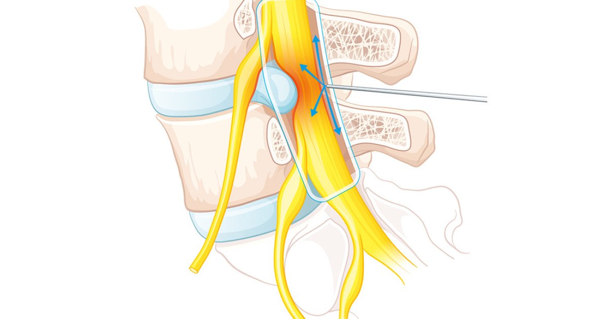 Therapeutische Infiltration An Der Wirbelsaule Schulthess Klinik