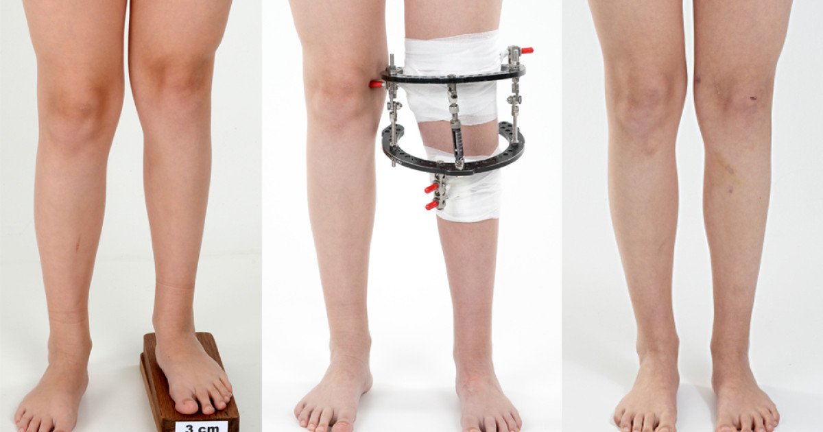 Leg lengthening without external fixation a new technique