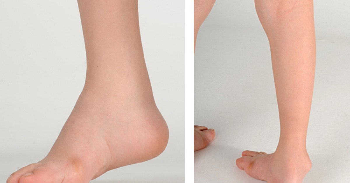 Severe Clubfoot In Older Children No Operation Necessary Schulthess Klinik Severe Clubfoot In Older Children No Operation Necessary Schulthess Klinik